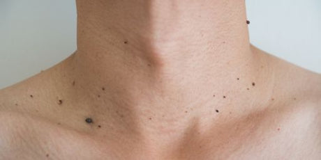 Hva er skin tags?